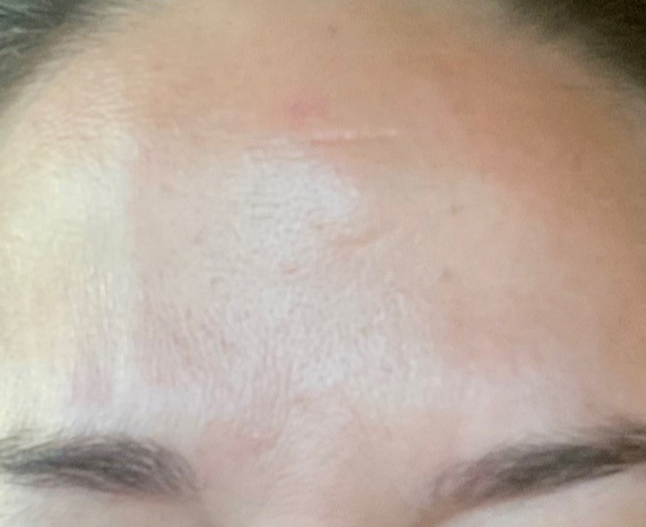 Glabella Complex After