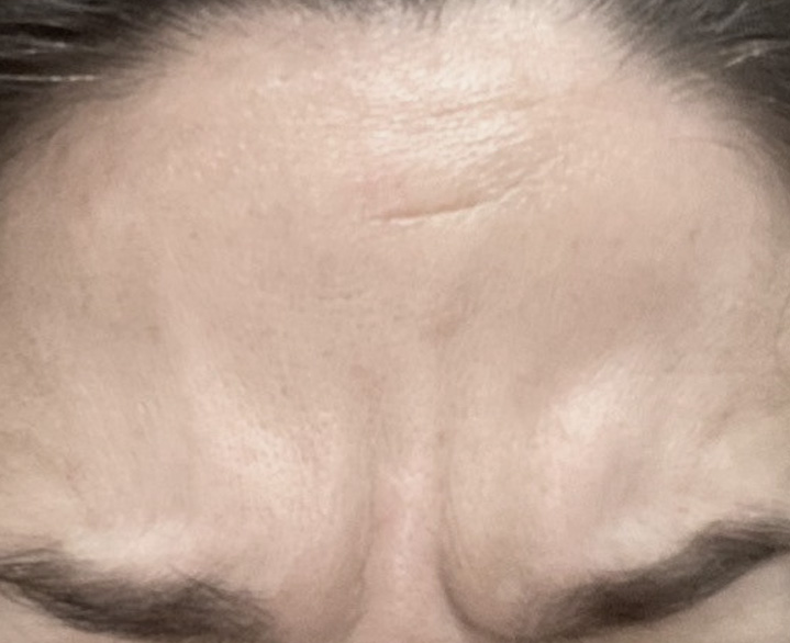 Glabella Complex Before