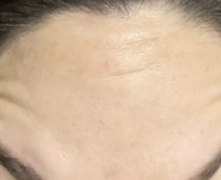 Frontalis Before