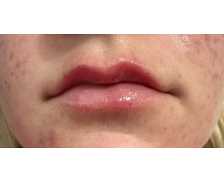 Lip Filler After