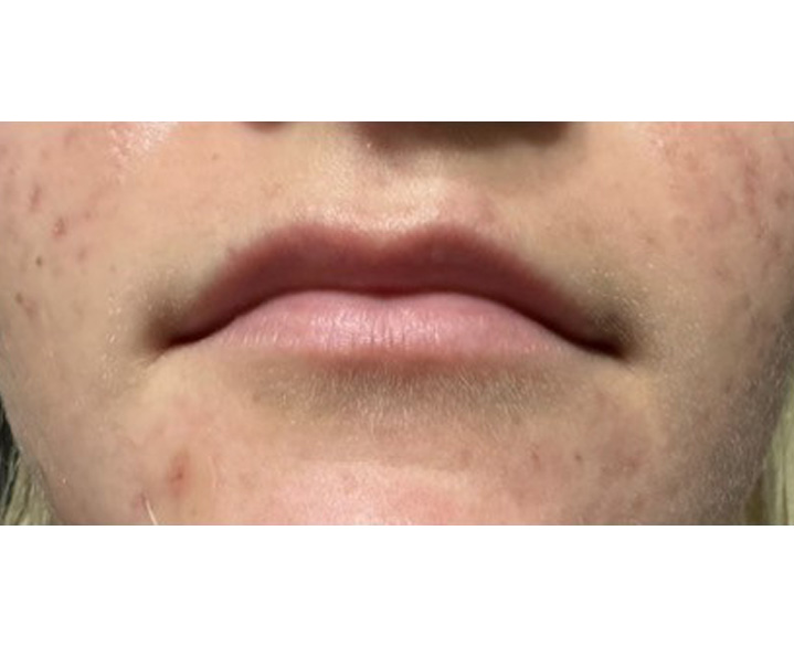 Lip Filler Before