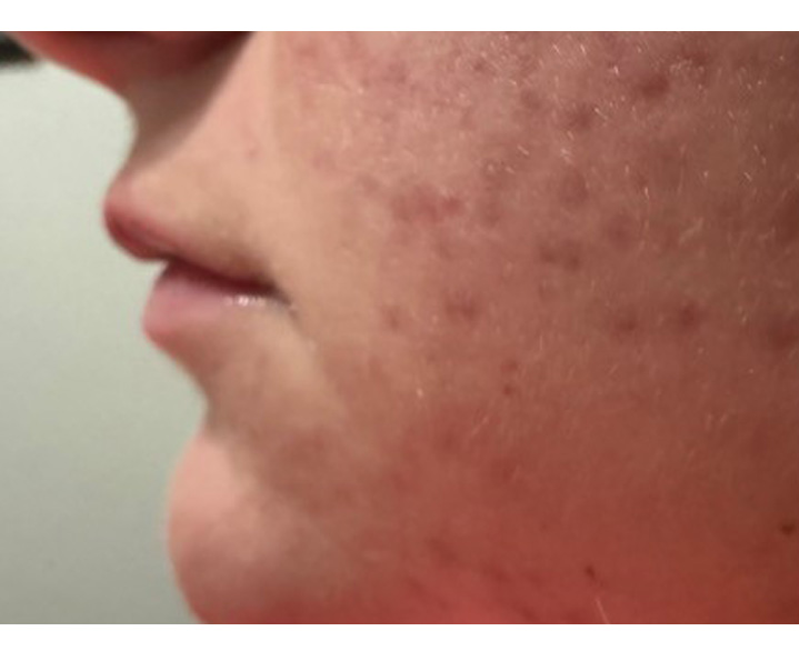Lip Filler After