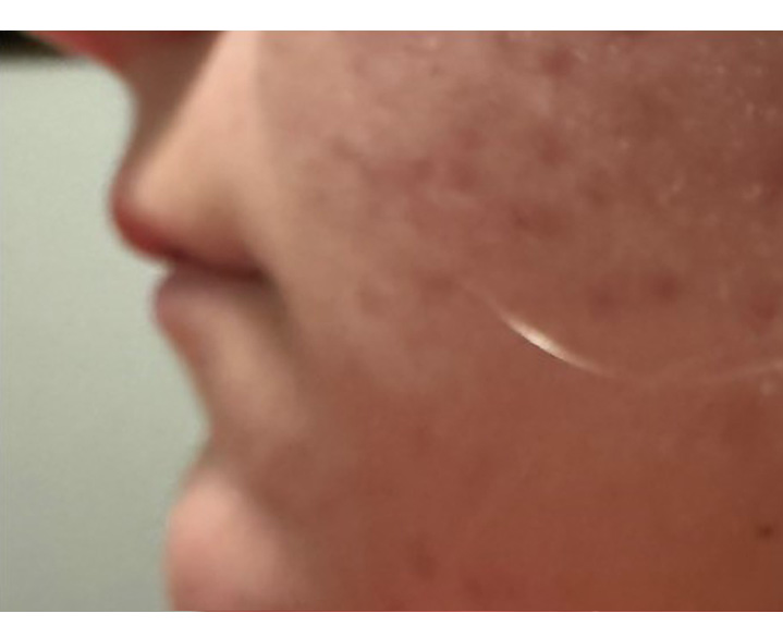 Lip Filler Before