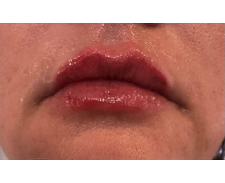 Lip Filler After