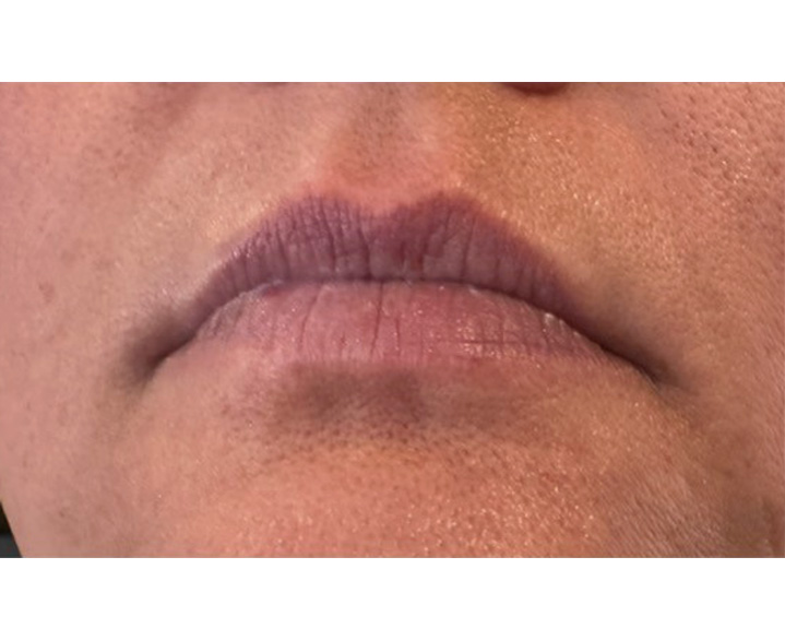 Lip Filler Before