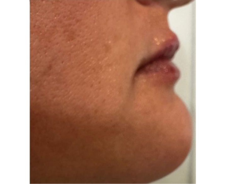 Lip Filler After