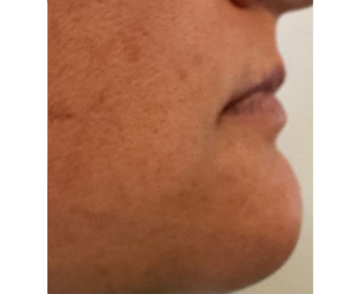 Lip Filler Before