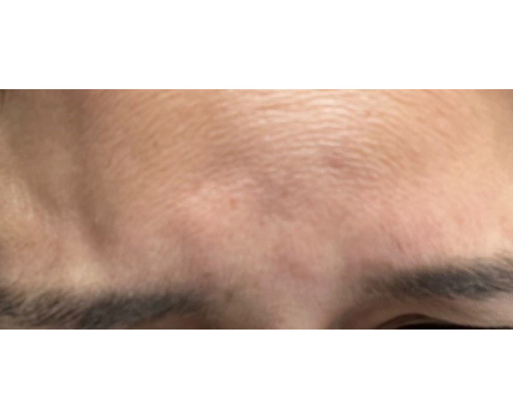 Glabella Complex After